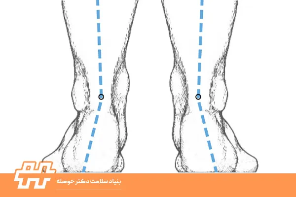 انحراف پاشنه