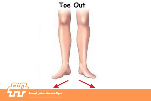 چرخش خارجی پاها