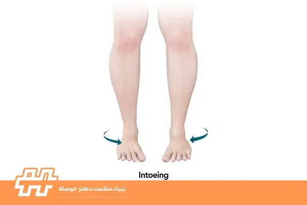 دوره سنی اصلاح پذیری In‑toeing