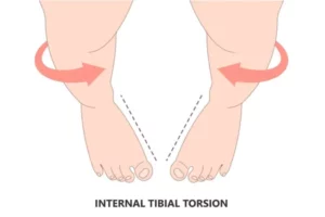 دوره سنی اصلاح پذیری In‑toeing