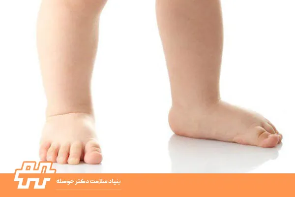 صافی کف پا در کودکان