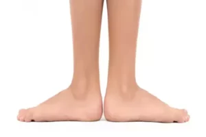 صافی کف پا در کودکان