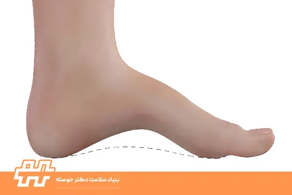 قوس زیاد پا