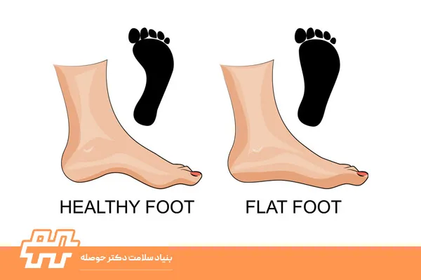 قوس زیاد پا