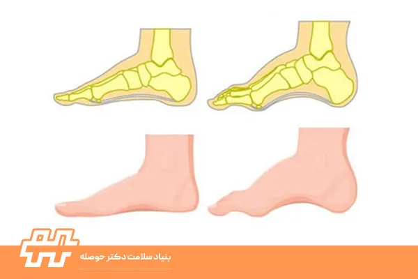 چگونه متوجه شویم پاهایمان قوس زیادی دارند
