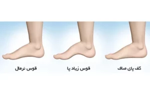 قوس زیاد پا