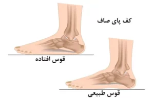 مقایسه کف پای گود و پای صاف