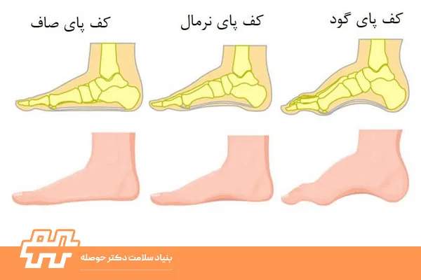 مقایسه کف پای گود و پای صاف