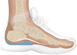 انحراف پاشنه