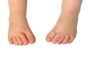 چرخش داخلی پاها در کودکان