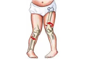 چرخش خارجی پاها