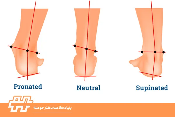 چگونه متوجه شویم پاشنه‌مان به داخل یا خارج متمایل است؟ تست‌های ساده در خانه