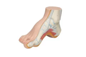 کف پای گود در کودکان