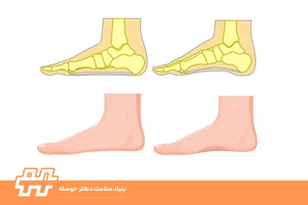 تشخیص صافی کف پا در خانه