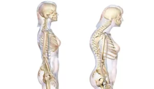 کیفوزیس پشت