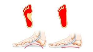 صافی کف پای انعطافپذیر و سخت