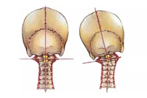عارضه مایل شدن سر به یک سمت