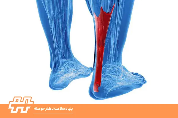 آزادسازی بافت نرم در درمان کوتاهی تاندون آشیل