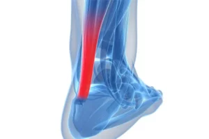  آزادسازی بافت نرم در درمان کوتاهی تاندون آشیل