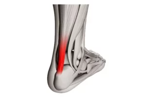 افزایش انعطاف تاندون آشیل