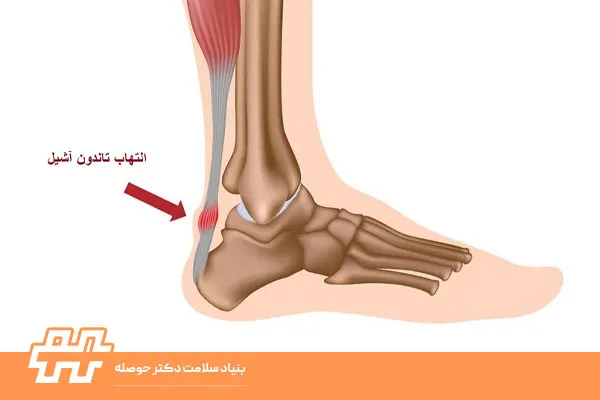 افزایش انعطاف تاندون آشیل