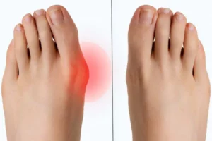 انحراف شست کج