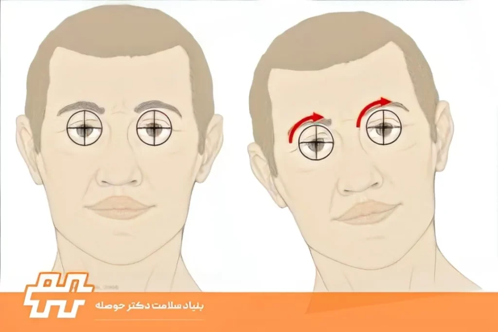 تأثیر کج‌شدن سر (Head Tilt) بر گردن، شانه‌ها و کمر