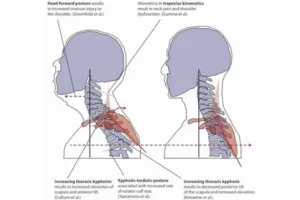 تأثیر کج‌شدن سر (Head Tilt) بر گردن، شانه‌ها و کمر