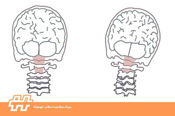 تأثیر کج‌شدن سر بر عملکرد روزمره