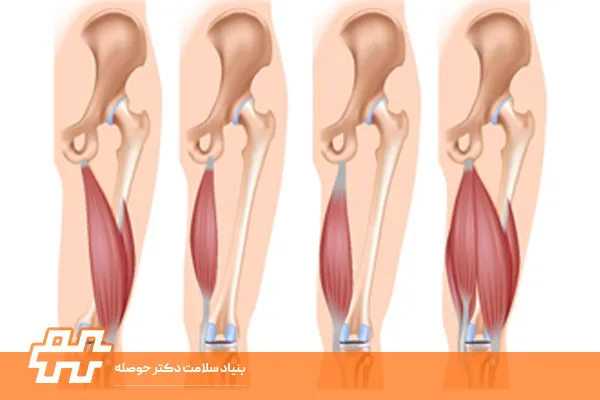 تأثیر کوتاهی همسترینگ بر راه رفتن