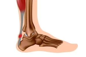 تاندون آشیل‌