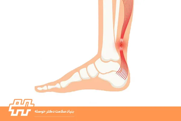 تاندون آشیل