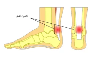 تاندون آشیل