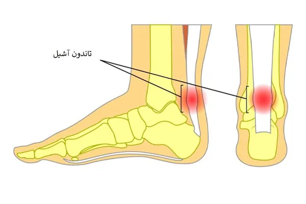 تاندون آشیل