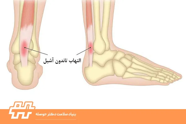 تاندون آشیل‌