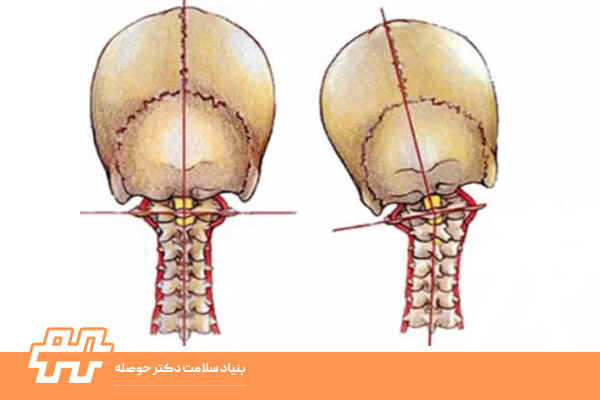 رفع کج‌شدن سر