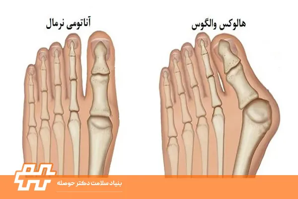 انحراف شست کج