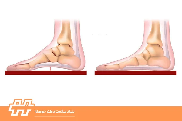 صافی کف پای انعطاف‌پذیر و سخت