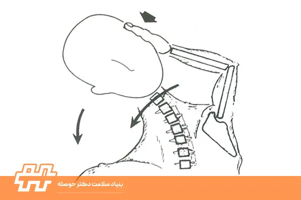 عارضه مایل شدن سر به یک سمت