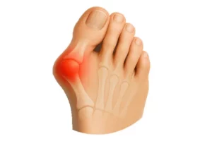 علل ساختاری و عملکردی ایجاد شست کج