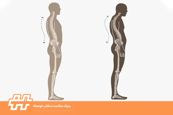 چطور بفهمیم قوس پشت‌مان زیاد شده؟