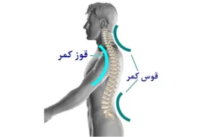 چطور بفهمیم قوس پشت‌مان زیاد شده؟