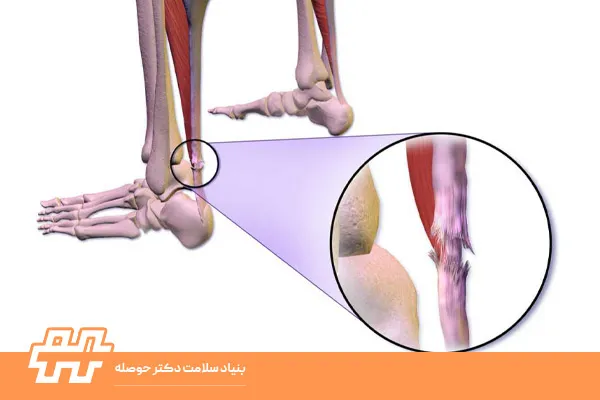 کوتاهی آشیل