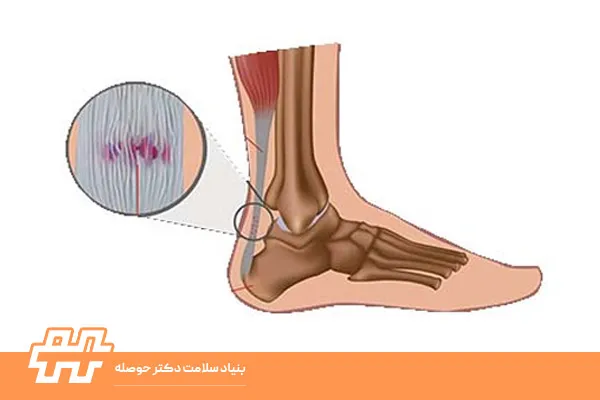 کوتاهی تاندون آشیل