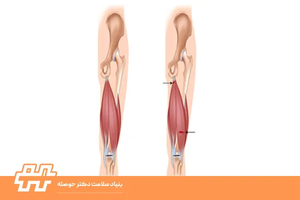 کوتاهی عضله همسترینگ
