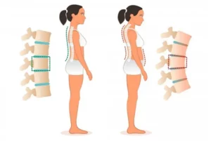 کیفوزیس پشت