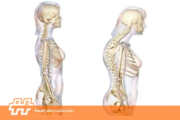 کیفوزیس پشت