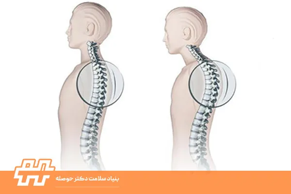 کیفوزیس پشت