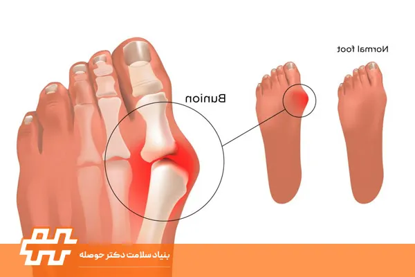 ۵ تمرین اصلاحی خانگی برای بهبود شست کج و کاهش درد