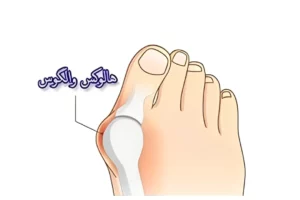 ۵ تمرین اصلاحی خانگی برای بهبود شست کج و کاهش درد